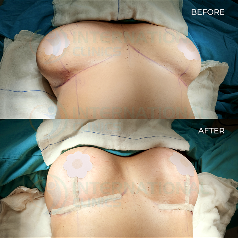 Breast Lift Before and After Images 